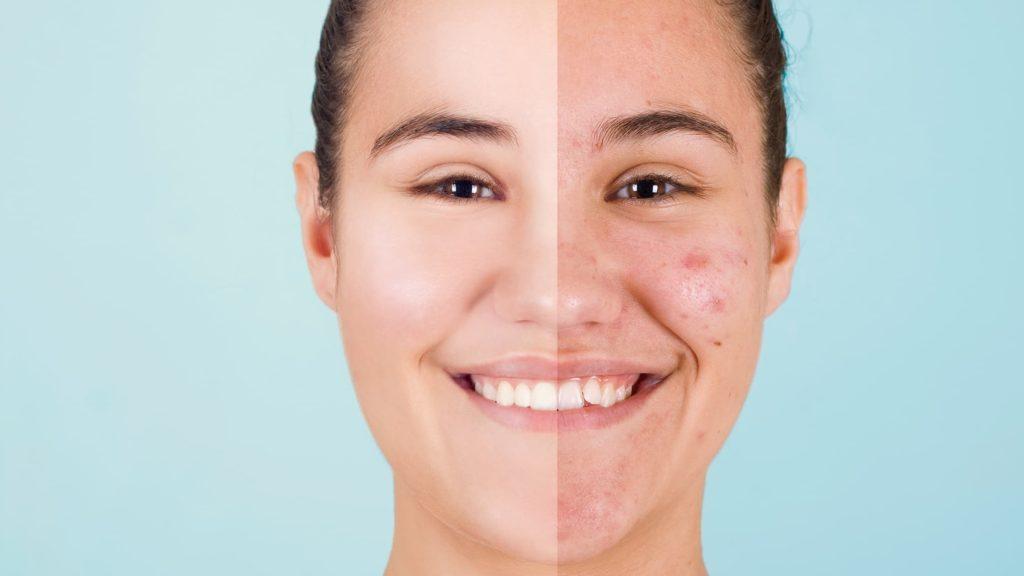 Rostro de una mujer dividido en dos mitades: una con acné y otra con la piel limpia